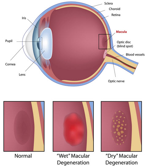 Macular Degeneration