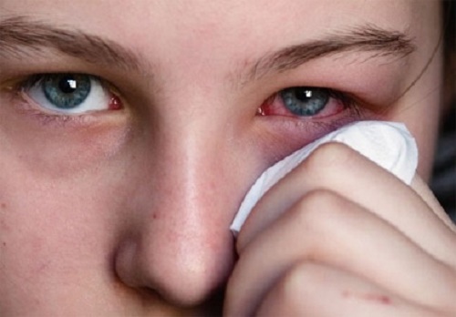 Ocular Infections & Inflammation